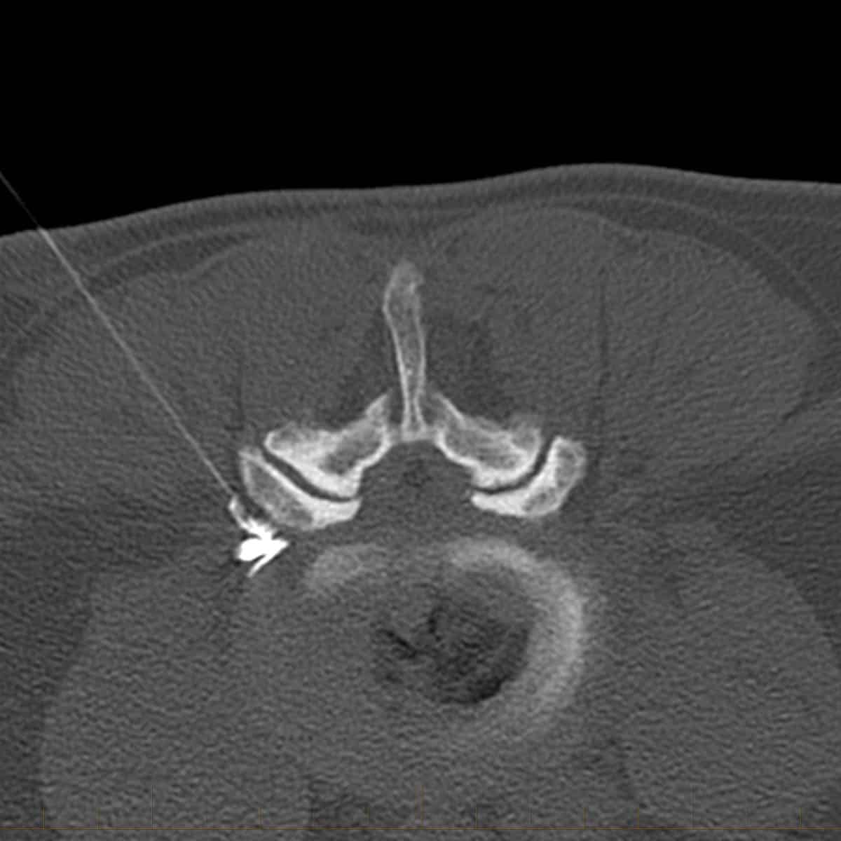 CT guided left L4 selective nerve root block (SNRB) lumbar spine