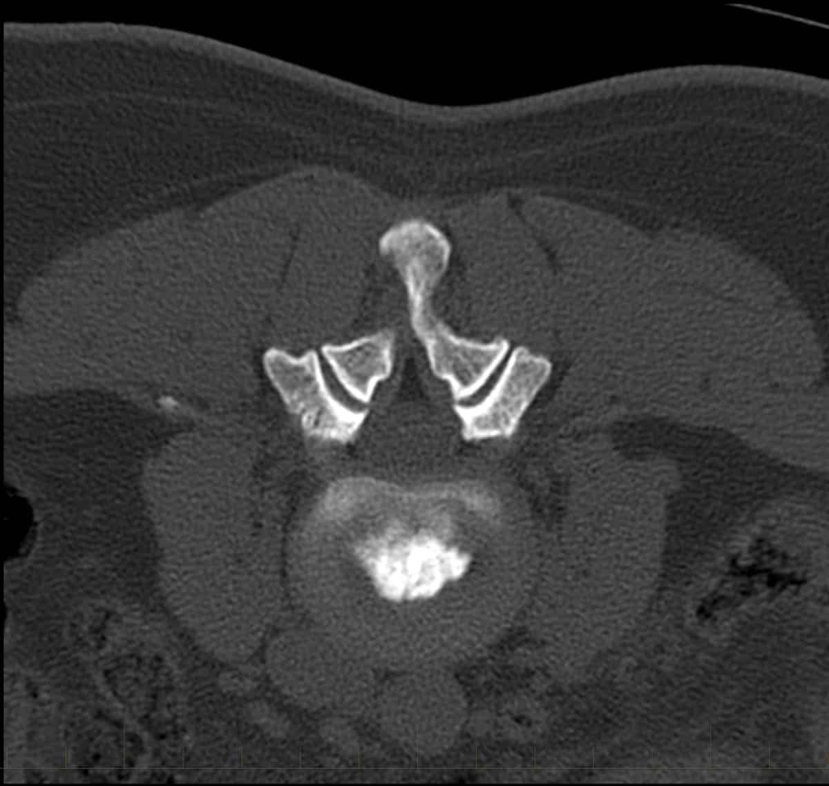 CT discogram (B). following injection of contrast, demonstrating normal flow of contrast within the disc.