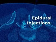 Epidural Injections - Patient Guide