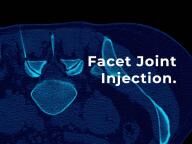 Facet Joint Injection - Patient Guide