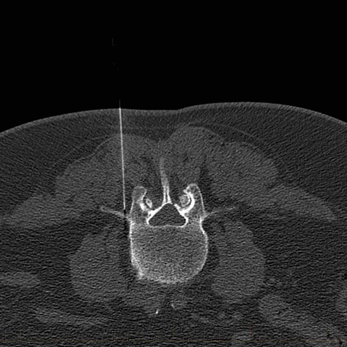 Medial branch block (MBB) - CT image guided spinal injection for pain management