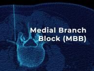 CT scan of a medial branch block injection