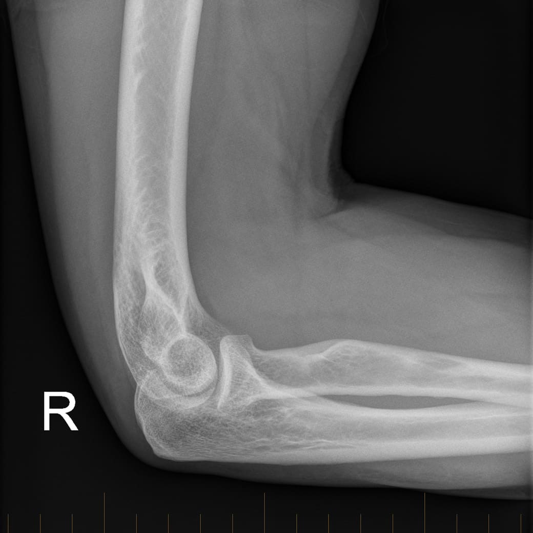 Gigital X-Ray of the right elbow - Melbourne Radiology Clinic
