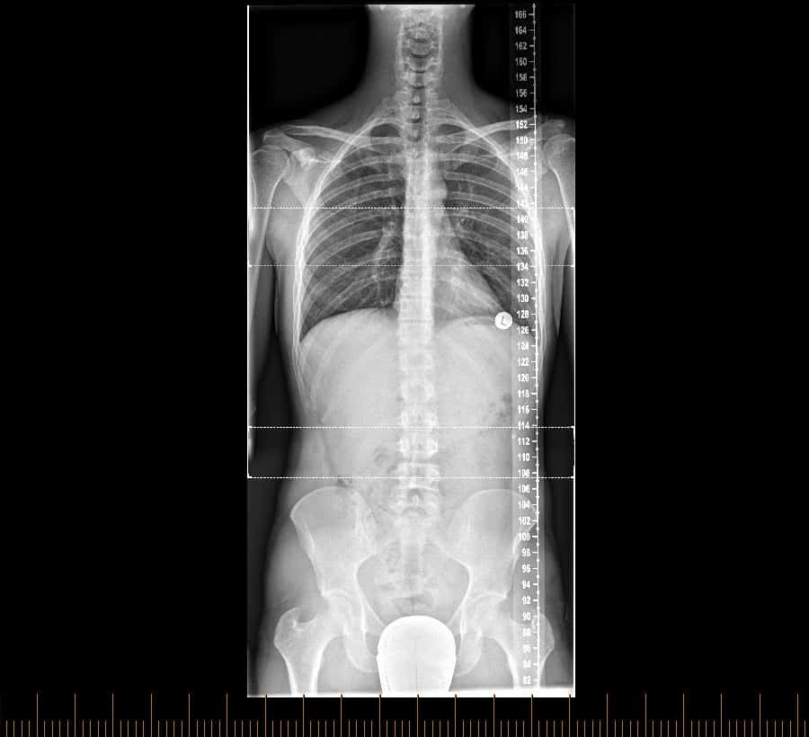 Full Spine X-Ray - Melbourne Radiology Clinic