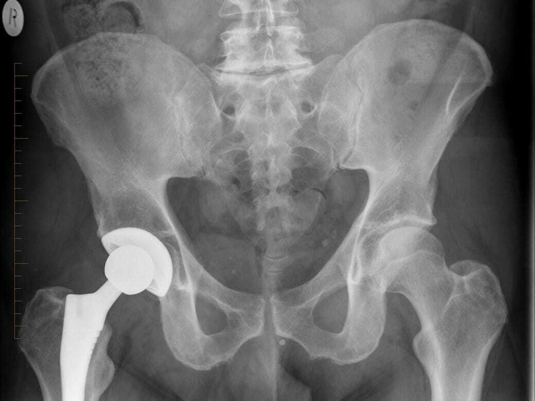 digital x-ray of a pelvis hip replacement - Melbourne Radiology Clinic