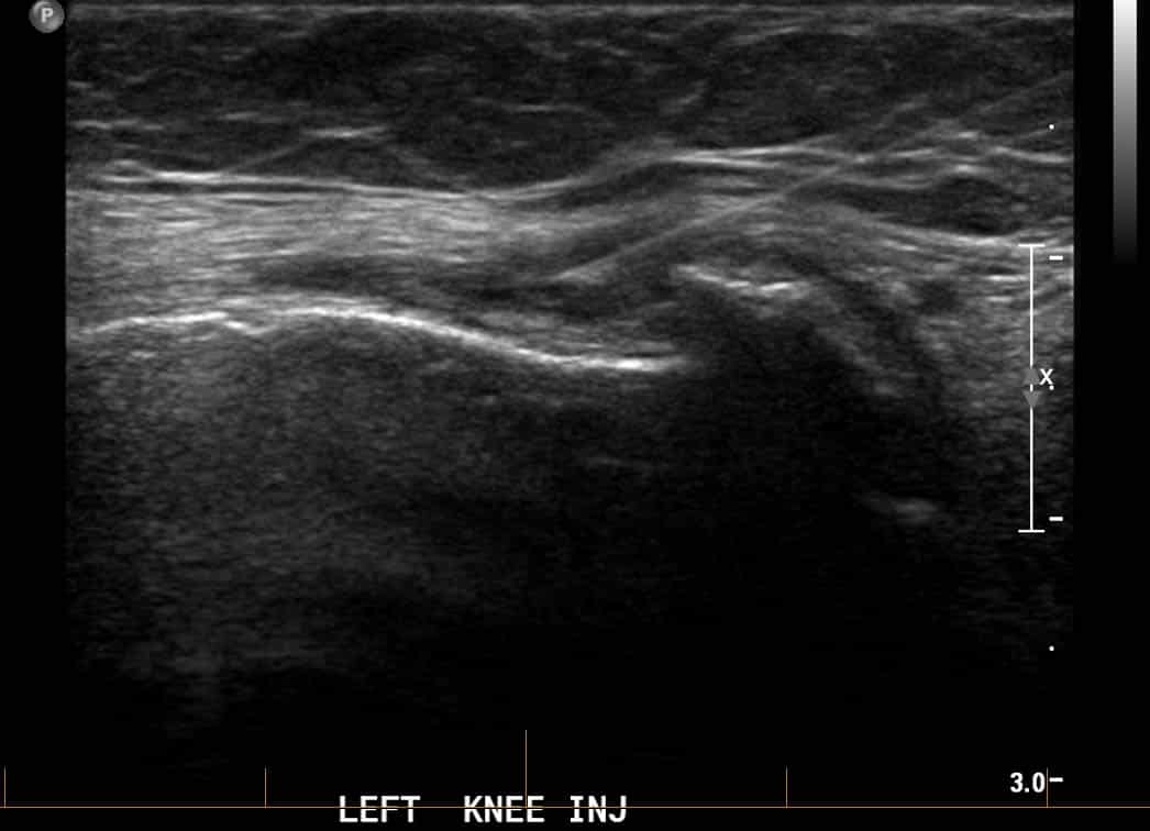 PRP injection - Left knee ultrasound guided injection