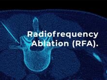 Radiofrequency Ablation (RFA) - Patient Guide