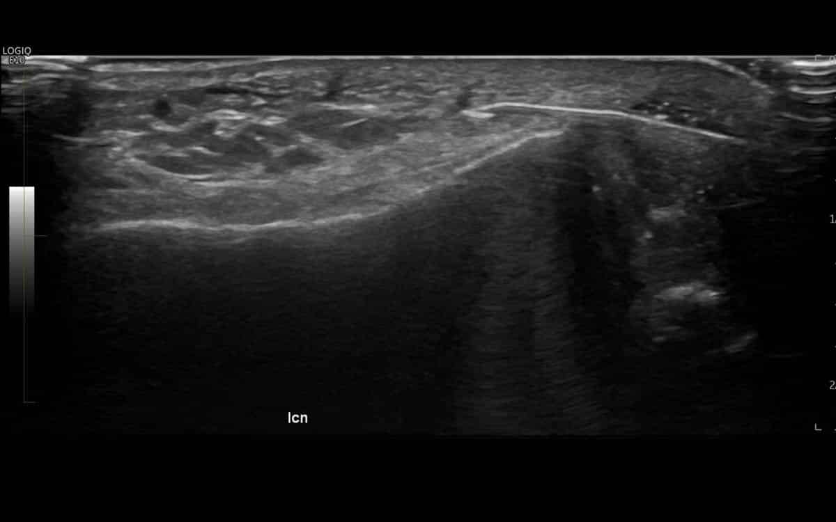 Radiofrequency Ablation - Performed with ultrasound imaging guidance to Achilles tendon to treat insertional tendinosis/enthesopathy