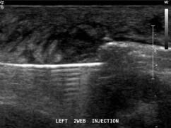 Radiofrequency Ablation - Performed with ultrasound imaging guidance to treat Morton’s neuroma