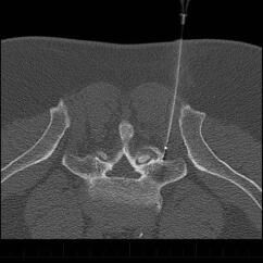 Radiofrequency Ablation - Performed with CT imaging guidance - right L5 medial branch