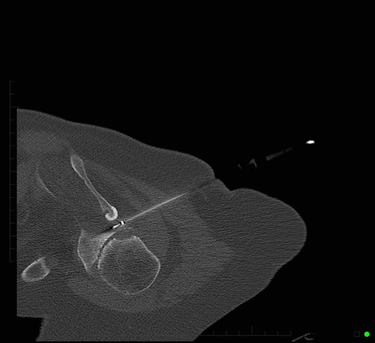 Radiofrequency Ablation - Performed with CT imaging guidance to the suprascapular nerve of the shoulder