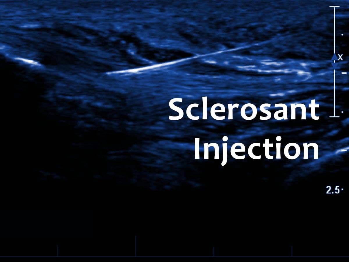 Sclerosant-Injection - Melbourne Radiology