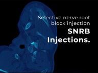 Selective nerve root block (SNRB) Injections - Patient Guide