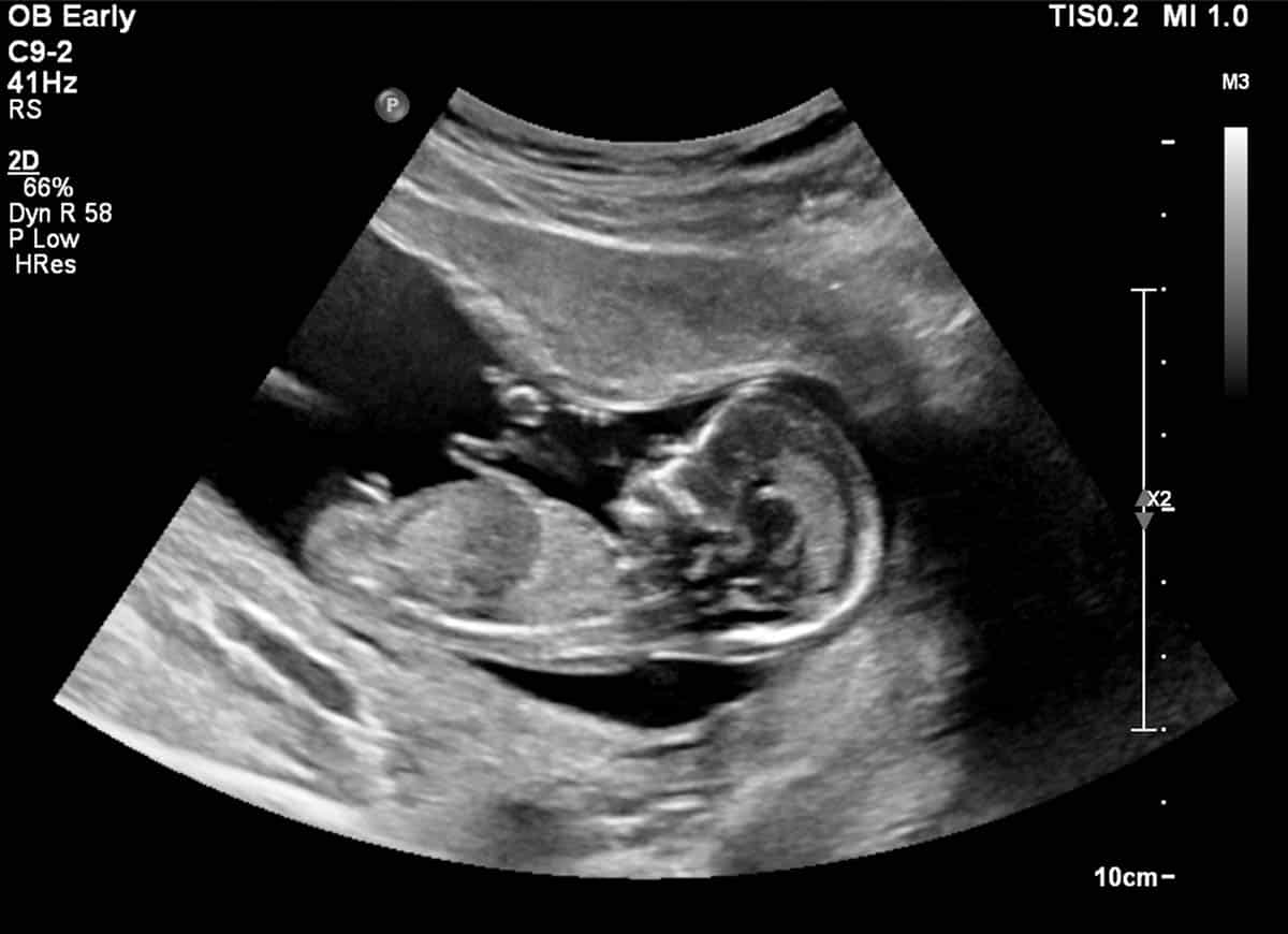 Obstetric Ultrasound - 1st Trimester Pregnancy Scan