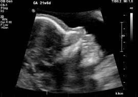 Obstetric Ultrasound - 2nd Trimester Pregnancy Scan at 21 weeks
