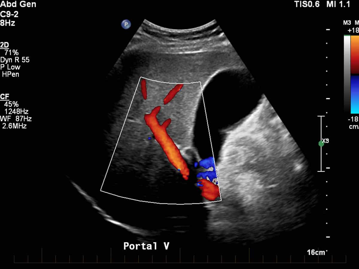 Ultrasound of abdomen demonstrating the portal vein