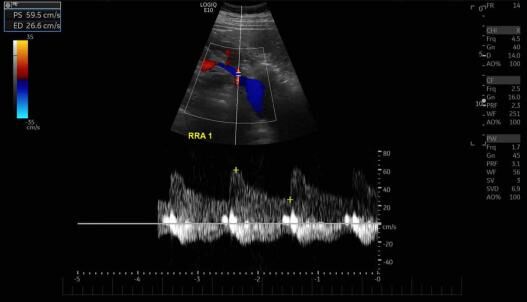 Renal Ultrasound - Colour doppler ultrasound examination of the right renal artery assessing flow within the vessel.
