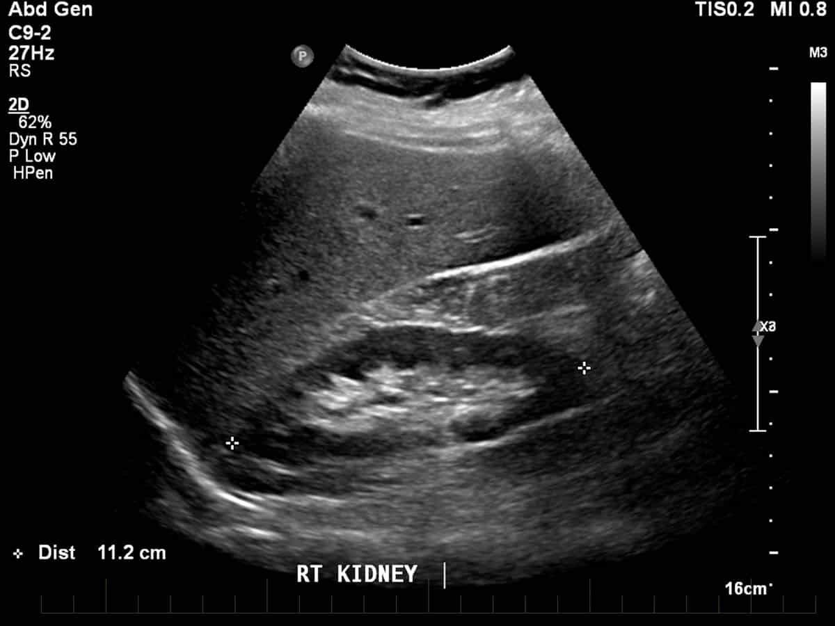 Ultrasound of abdomen demonstrating the right kidney