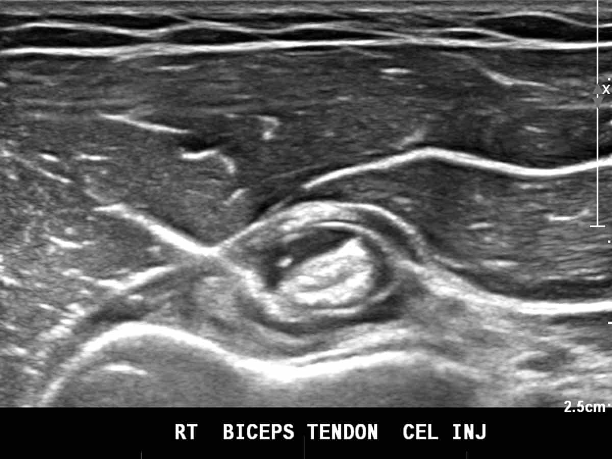 ultrasound of an injection to a biceps tendon
