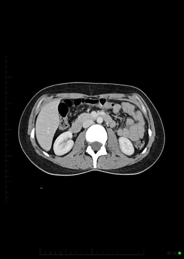 1. Routine contrast enhanced CT of abdomen and pelvis