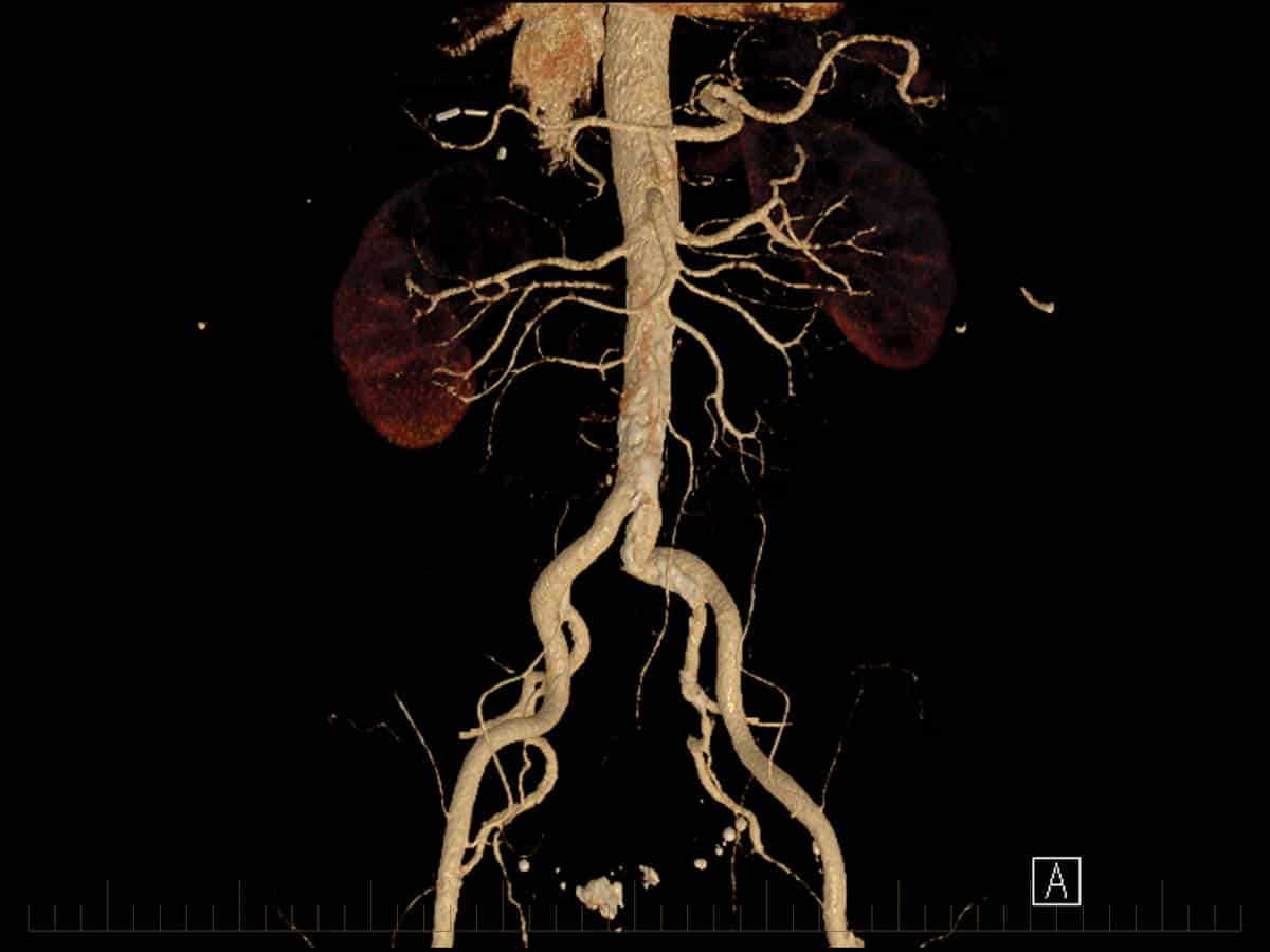 CT Angiogram - Contrast Enhanced