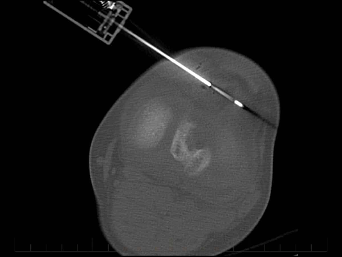CT guided right knee soft tissue lesion