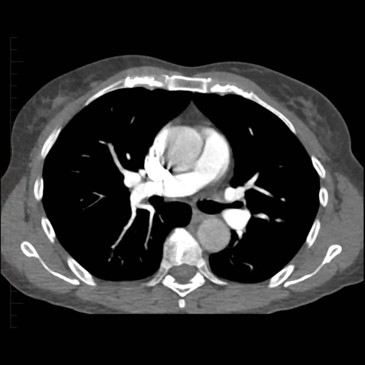 CT scan of a pulmonary angiogram