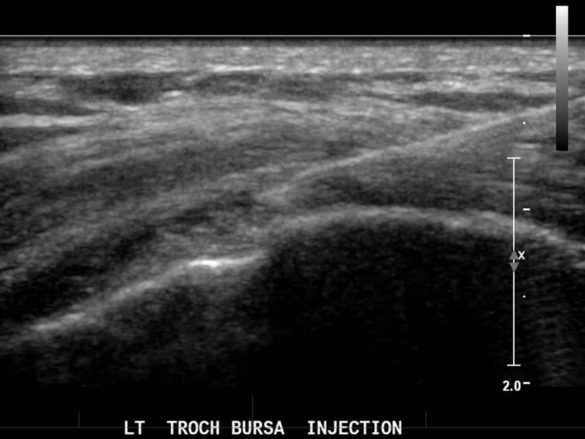 ultrasound of a trochanteric bursa injection