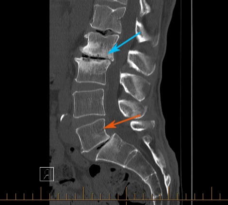 Lumbar spine CT demonstrating severe disc degeneration and slippage (spondylolisthesis) of two vertebral bodies