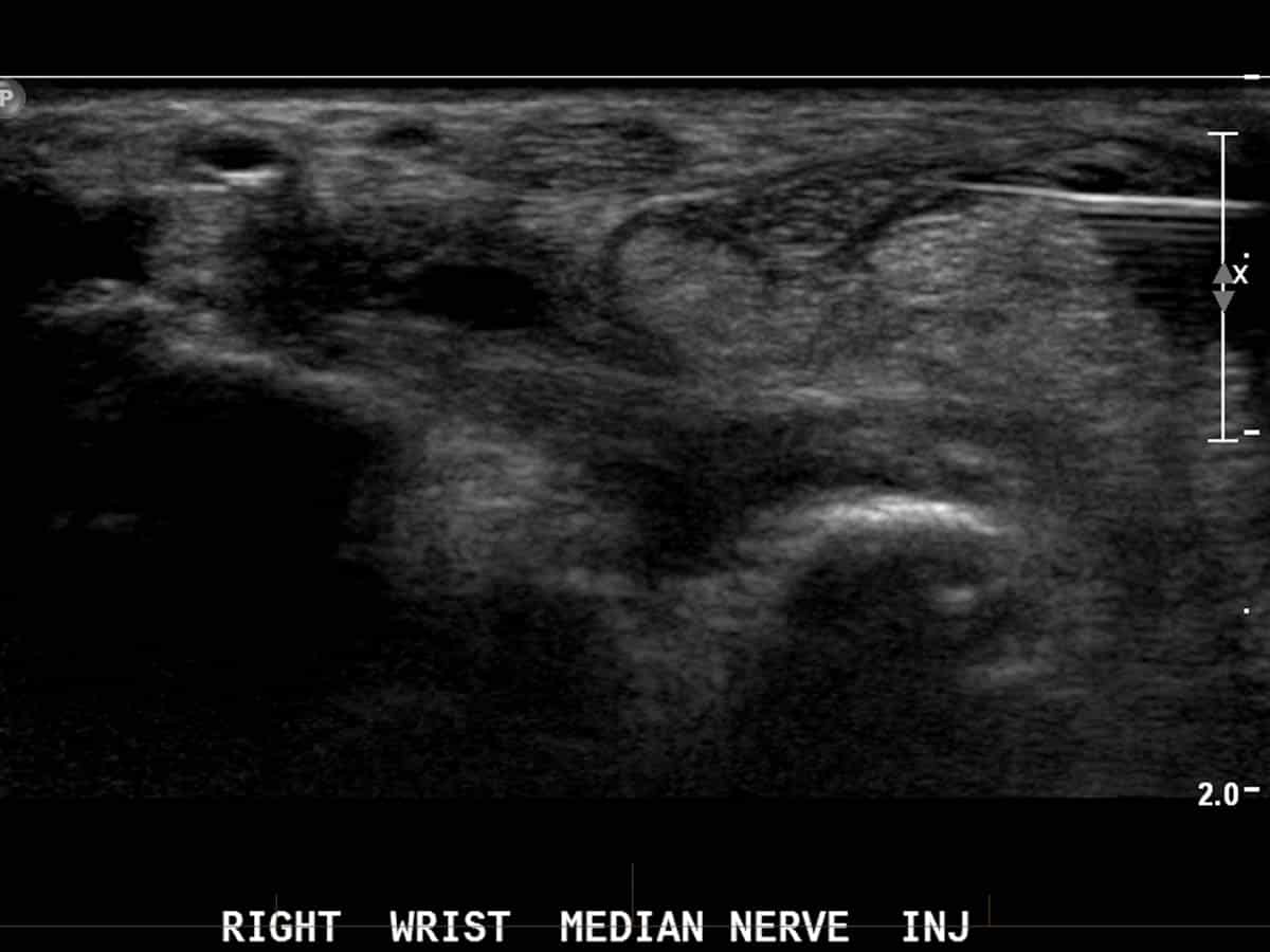 ultrasound guided injection to treat carpal tunnel syndrome