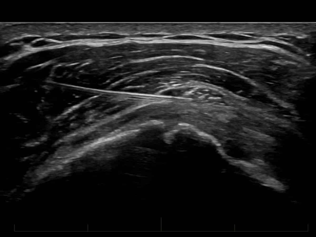 ultrasound of a subacromial bursa injection