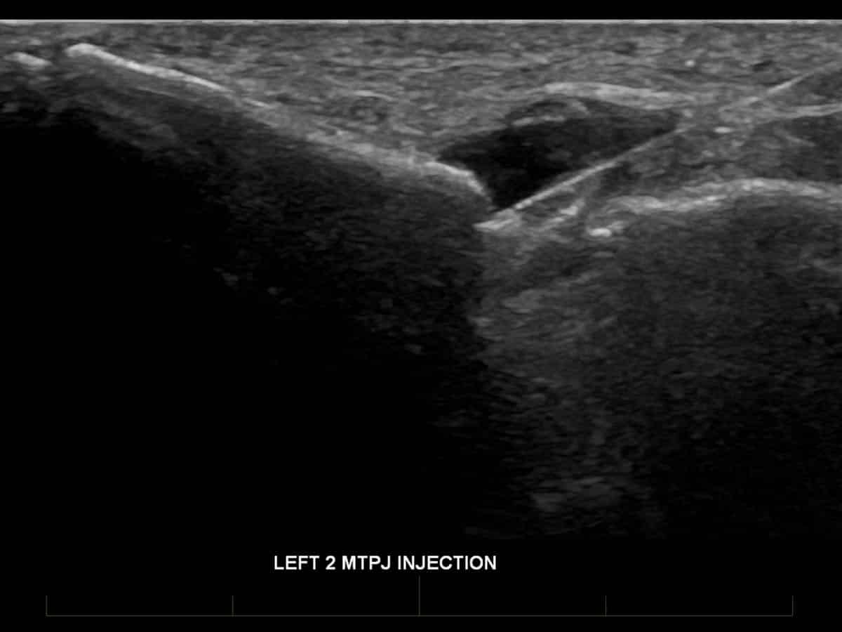 ultrasound of a metatarsophalangeal joint injection