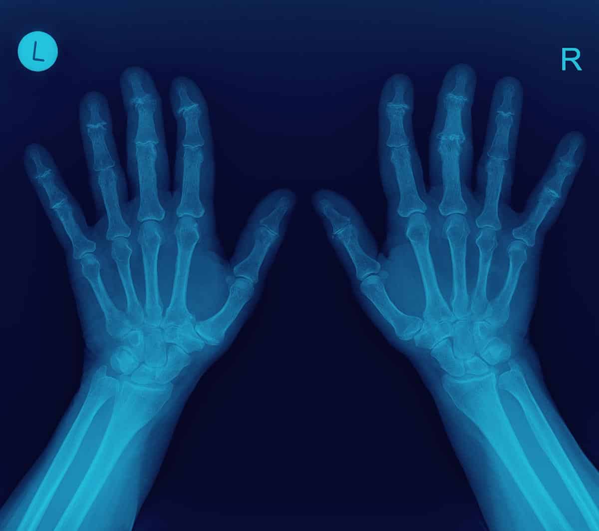 digital x-ray of both hands