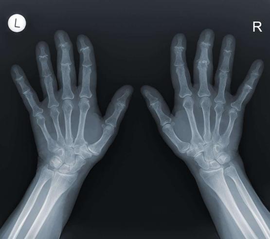 Hand X-Ray - Melbourne Radiology Clinic
