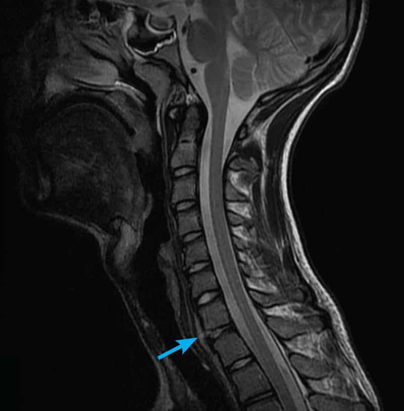 cervical spine MRI scan