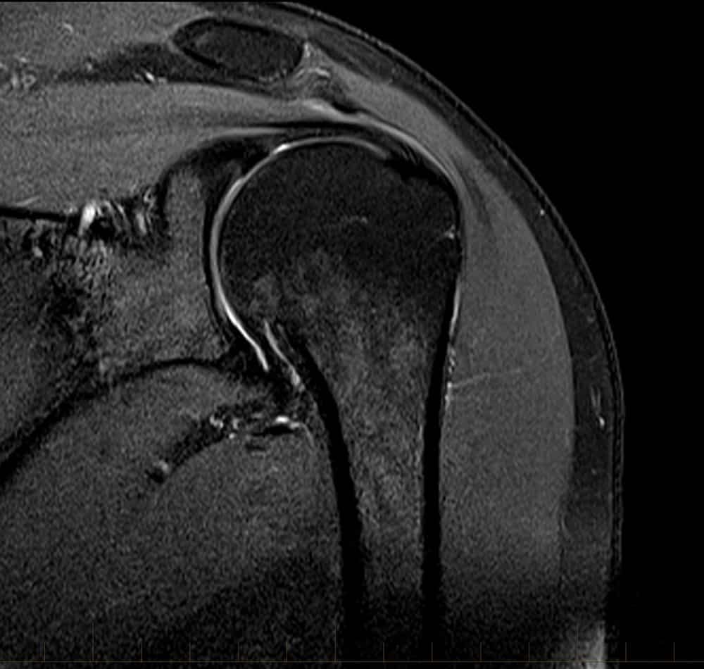 MRI of shoulder rotator cuff tear
