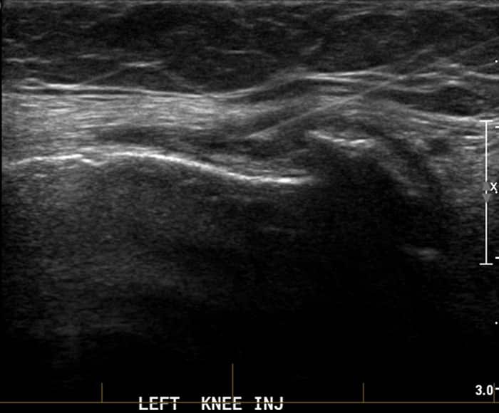 An ultrasound machine is used to guide the safe and accurate delivery of PRP into a patient's arthritic knee.
