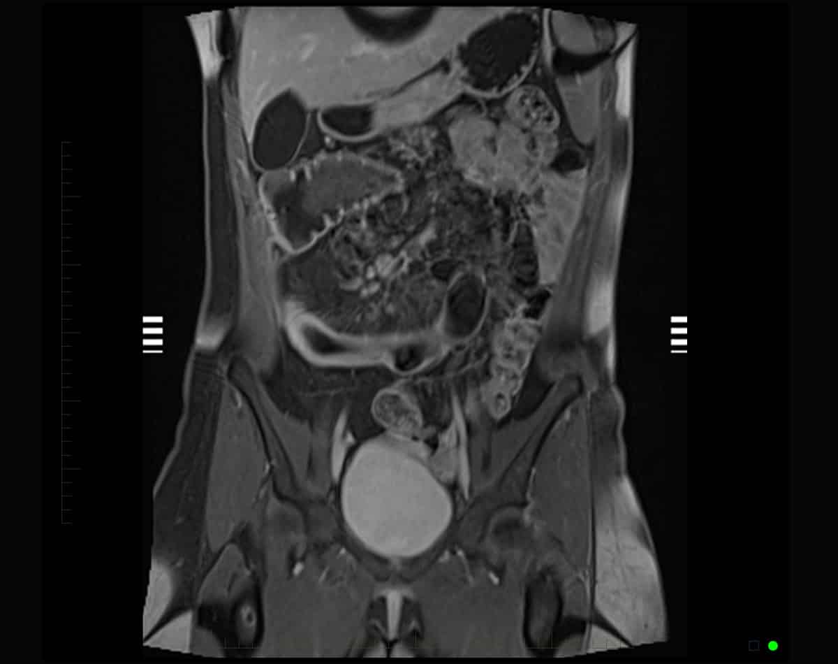 MRI scan of a small bowel or intestine