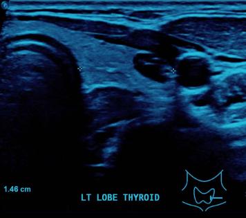 thyroid ultrasound