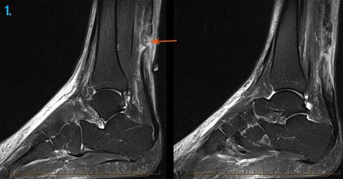 MRI of an ankle