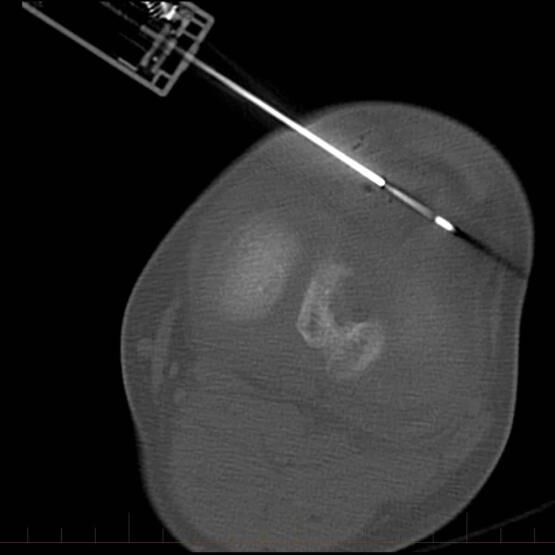 CT guided right knee soft tissue lesion biopsy