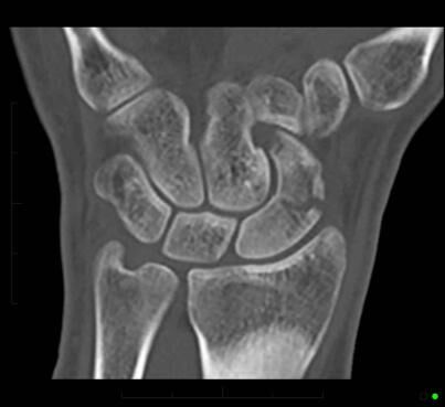 CT imaging of the wrist demonstrates a horizontally orientated fracture through the scaphoid