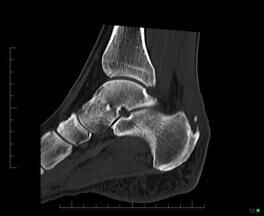 3A. Sagital CT reformatted image of the ankle demonstrates insertional calcification of the Achilles tendon (arrow) in keeping with enthesophyte formation.
