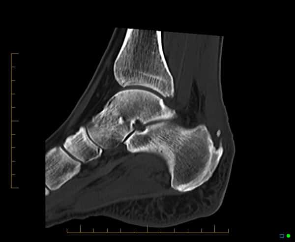3A. Sagital CT reformatted image of the ankle demonstrates insertional calcification of the Achilles tendon (arrow) in keeping with enthesophyte formation.