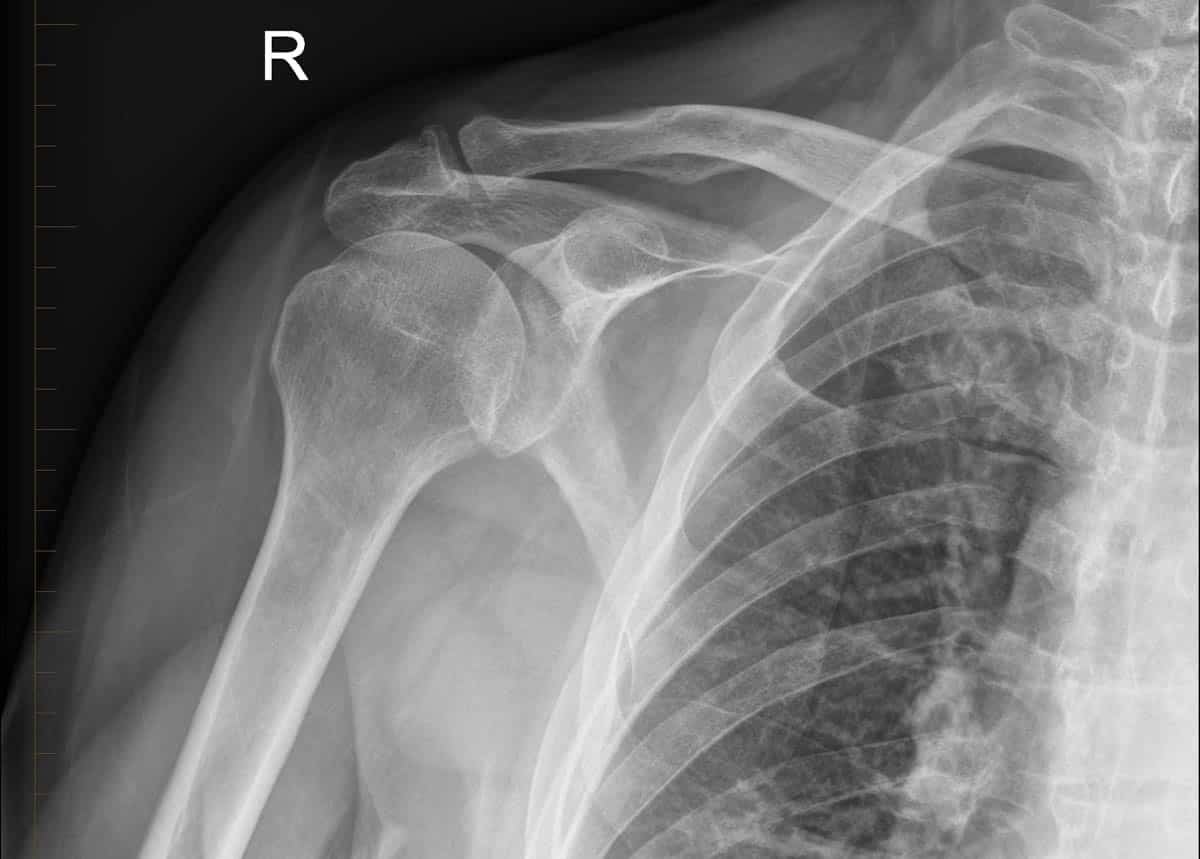 Normal frontal (anteroposterior) radiograph of the right shoulder.