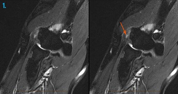 MRI scans of a tennis elbow