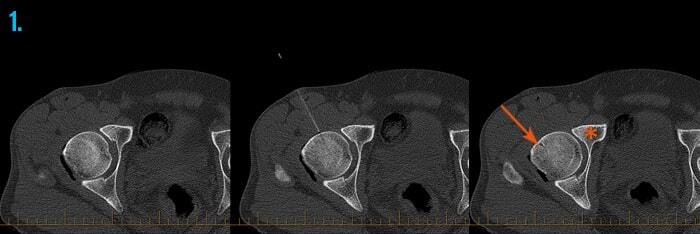 CT scan guided hip injection