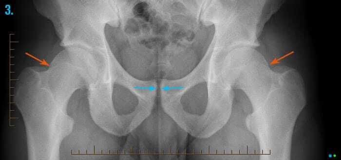 x-ray of the hip