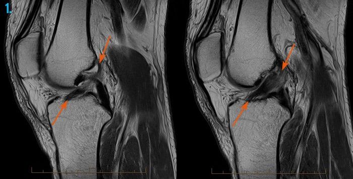 MRI of the knee with ACL tear