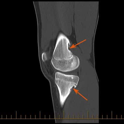 MRI of a knee